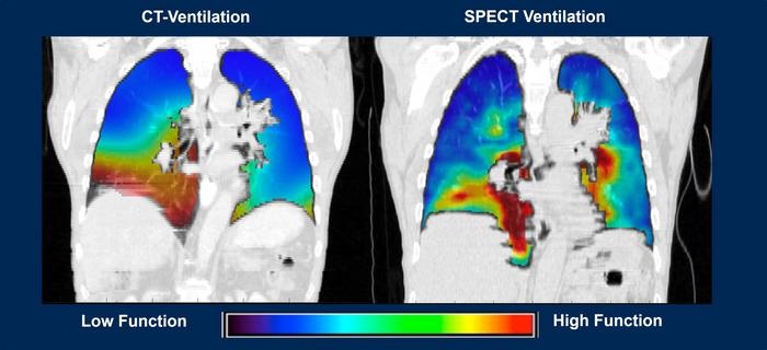 La imagen muestra similitudes entre las áreas de la función pulmonar obtenidas en el mismo paciente con CTFI y SPECT (foto cortesía de Corewell Health)
